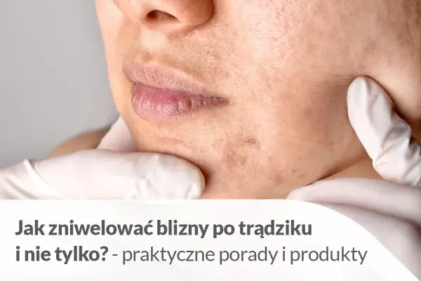 Jak usunąć blizny domowym sposobem? Zbliżenie na skórę z widocznymi śladami po trądziku, sugerujące poszukiwanie rozwiązań.